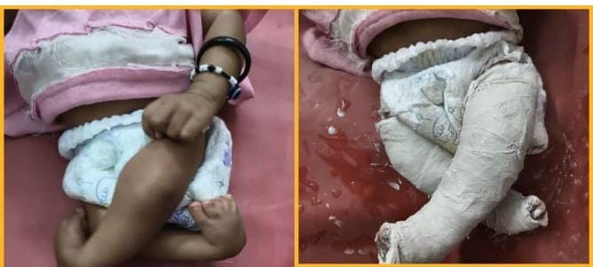 क्लब फुट का समय पर इलाज बना बच्चों के लिए वरदान, पोंसेटी तकनीक से मिल रही नई जिंदगी,260 से अधिक बच्चों को क्लब फुट से मिली मुक्ति